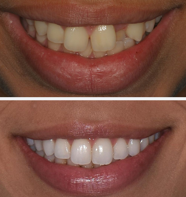 Arch alignment before and after Invisalign case, Coimbatore