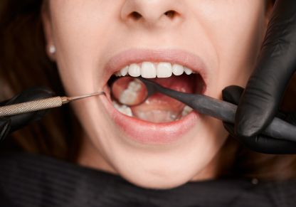 Dental filling treatment performed by experienced dentist in Coimbatore