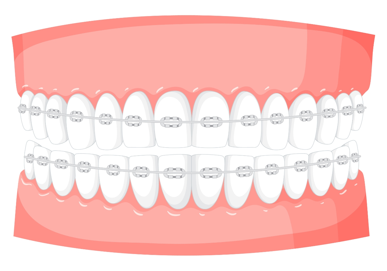 Teeth clip treatment in Coimbatore for affordable orthodontic correction
