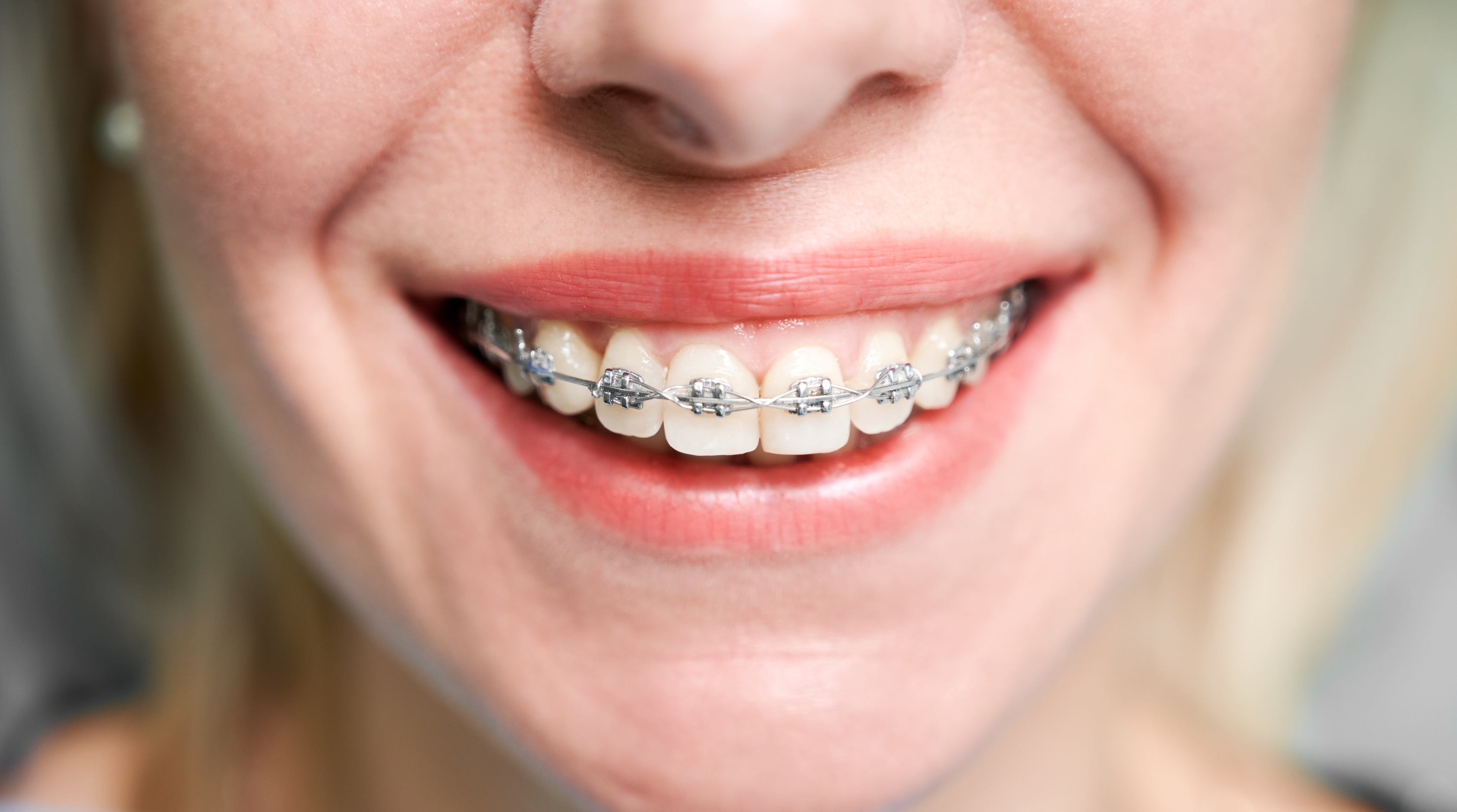 Affordable teeth clip treatment in Coimbatore for perfectly aligned teeth