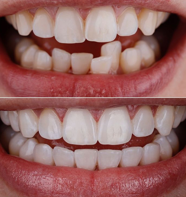 Crowding before and after Invisalign case, Coimbatore