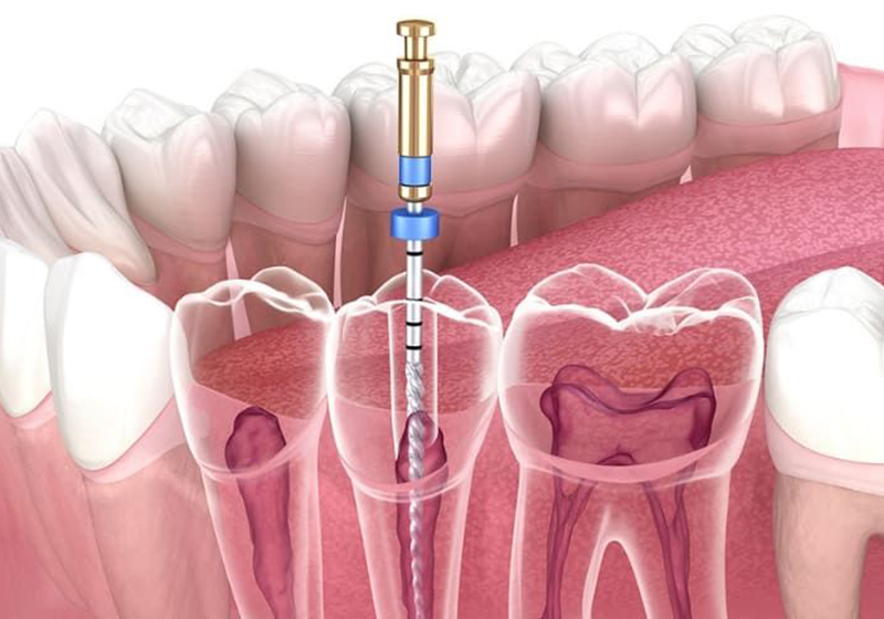 Dentist performing root canal treatment at Uniq Dental Clinic in Coimbatore