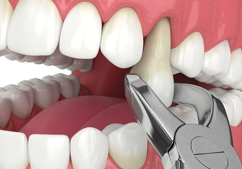 Tooth extraction cost in Coimbatore | Safe, painless extraction treatment | Transparent pricing